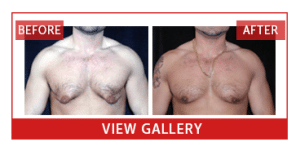 gynecomastia before and after photos in Boston, MA