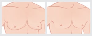 Before & After Gynecomastia