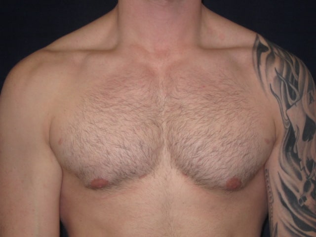 Gynecomastia