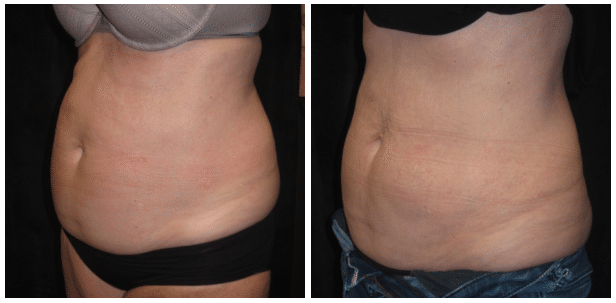 SculpSure Patient Before & After Photo - Boston, MA 