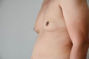 Gynecomastia Newton MA | Boston