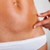 How to Take Care of Your Scars So That You Don’t End Up Looking Worse Than Frankenstein plastic surgery Boston, MA