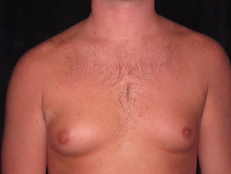 Patient with Gynecomastia Patient with Gynecomastia