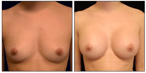 Breast Augmentation BeforeAfter Dr Rick Silverman