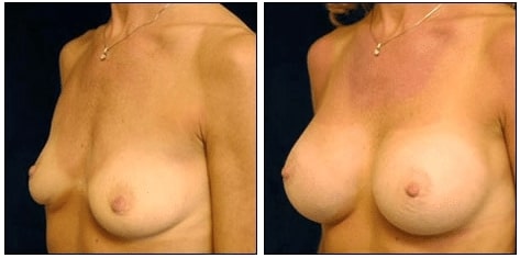 Breast Implants Before After Submuscular Placement