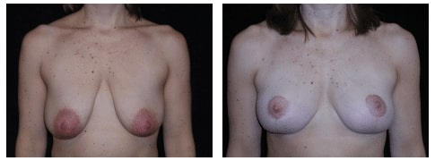 Breast Lift Before After Photo