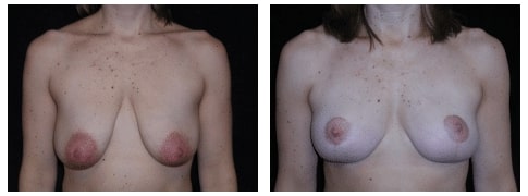 Before and After image of Breast Lift Boston MA