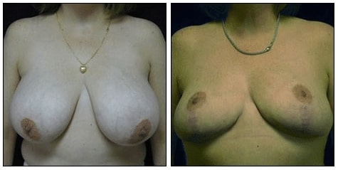 Breast Reduction Surgery Before and After