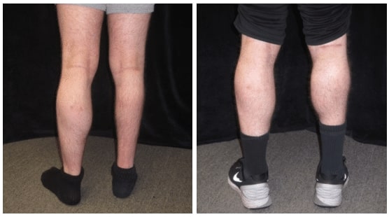 Calf Augmentation Patient Before After Photo