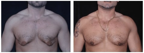GYNECOMASTIA WITH SKIN EXCISION BEFORE AND AFTER Dr. Rick Silverman
