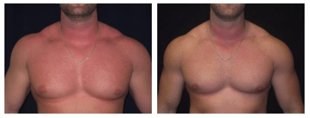 Gynecomastia Before After