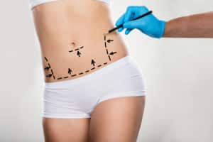 Liposuction Dr. Rick Silverman