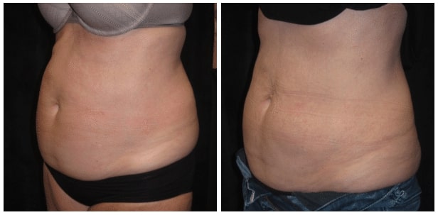 SculpSure Patient Before After Photo Boston