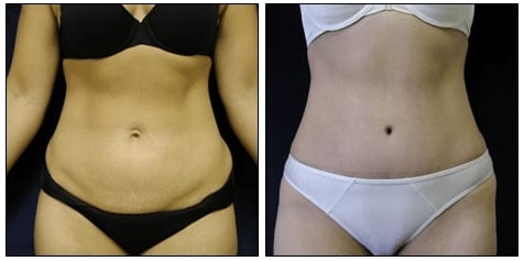 Tummy Tuck Results 1