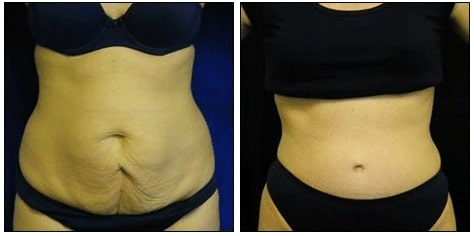 Tummy Tuck Surgery before after
