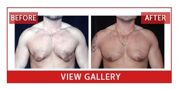 beforeaftergynecomastia 1