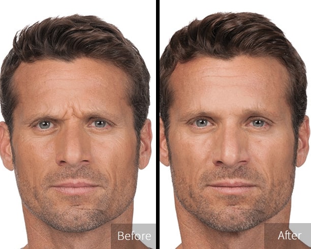 before & after photo of man after getting botox