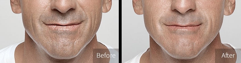 restylane ba silverman