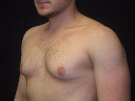 Before Image: Patient # 15636 - left-front-oblique