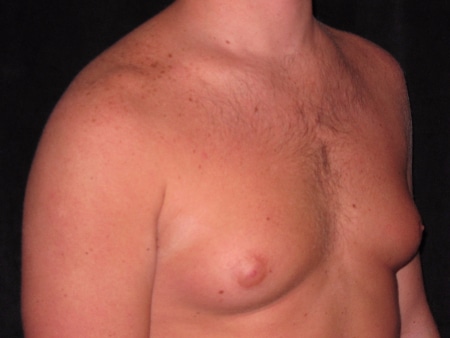 Before Image: Patient # 21546 - right-front-oblique