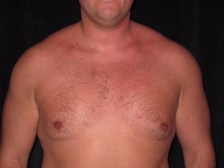 Before Image: Patient # 44591 - front
