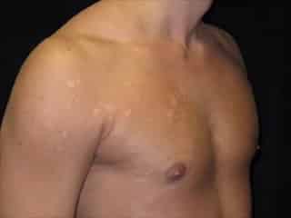 After Image: Patient # 45419 - right-front-oblique