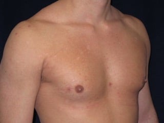 Before Image: Patient # 45419 - right-front-oblique