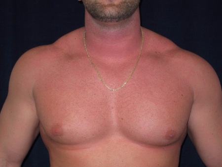 Before Image: Patient # 57381 - front
