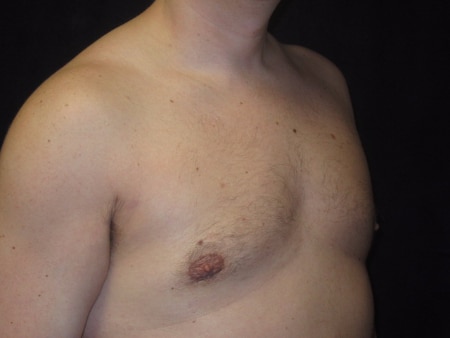 After Image: Patient # 91185 - right-front-oblique