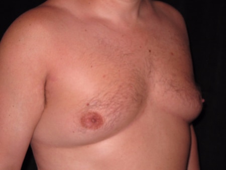 Before Image: Patient # 91185 - right-front-oblique