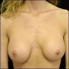 After Image: Patient # 10685 - front