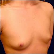 Before Image: Patient # 10685 - right-front-oblique