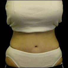 After Image: Patient # 12504 - front