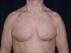 After Image: Patient # 27997 - front