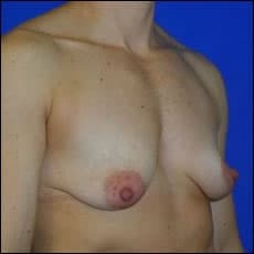 Before Image: Patient # 30583 - right-front-oblique