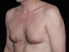 Before Image: Patient # 33640 - left-front-oblique