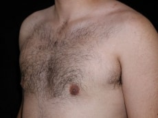After Image: Patient # 33791 - left-front-oblique