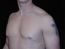 After Image: Patient # 53095 - left-front-oblique