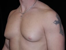 Before Image: Patient # 53095 - left-front-oblique