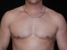 After Image: Patient # 57751 - front