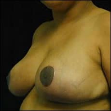 After Image: Patient # 73887 - left-front-oblique