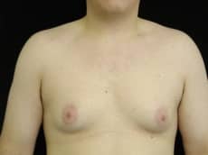 Before Image: Patient # 74336 - front
