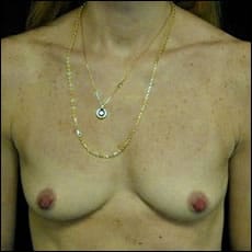 Before Image: Patient # 80691 - front